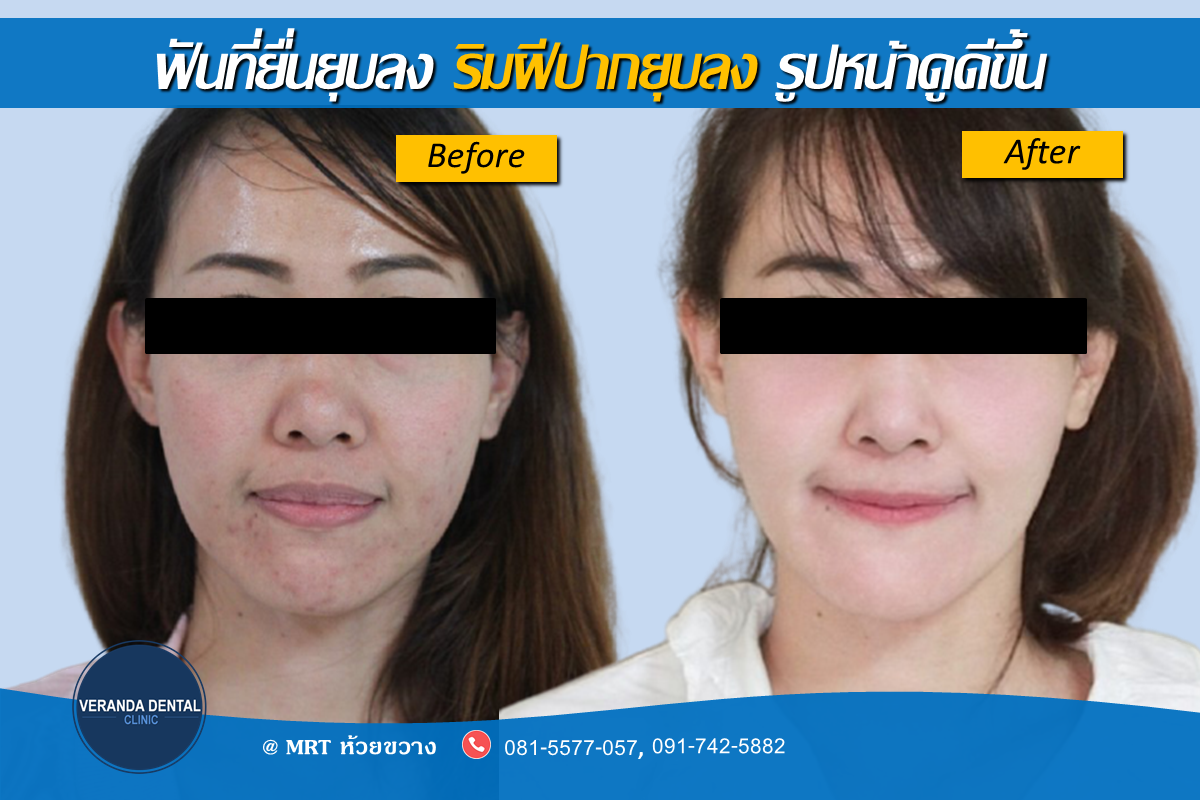 จัดฟันแล้วสวยขึ้น