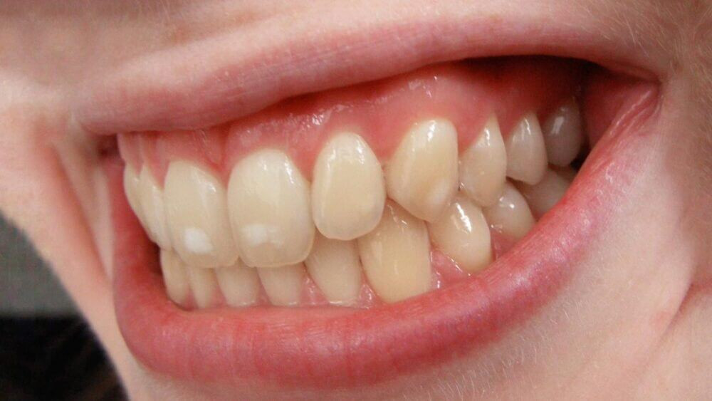 Dental Fluorisis