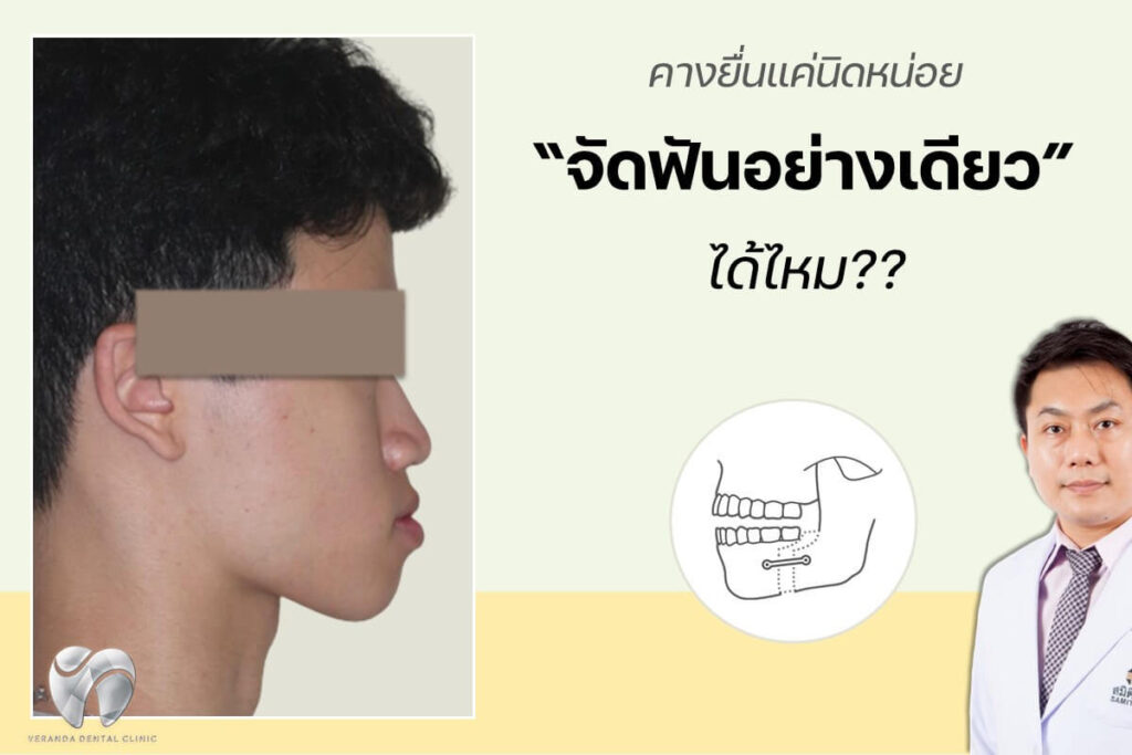คางยื่นไม่ผ่าตัดขากรรไกร