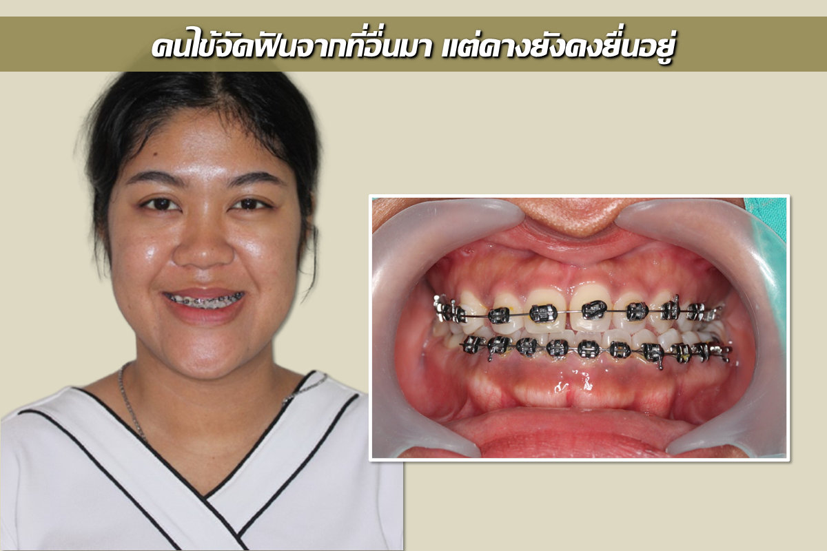 รีวิวผ่าตัดเลื่อนขากรรไกร