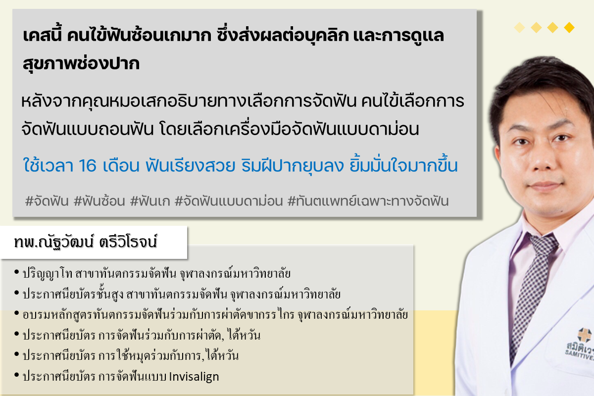 จัดฟันแบบดามอนโดยทันตแพทย์เฉพาะทาง